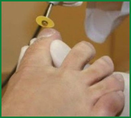 Laserterapia