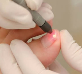 laserterapia